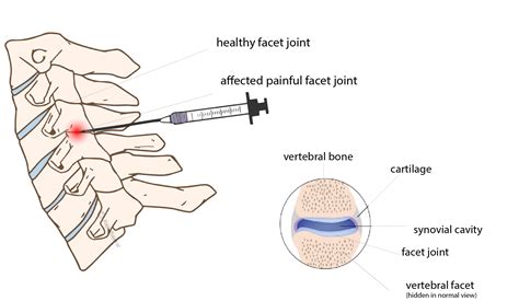 Facet Joint Injections - Rajiv Bajekal