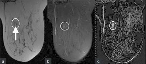 Intramammary lymph node. (a) T1W MR image without fatsuppression... | Download Scientific Diagram