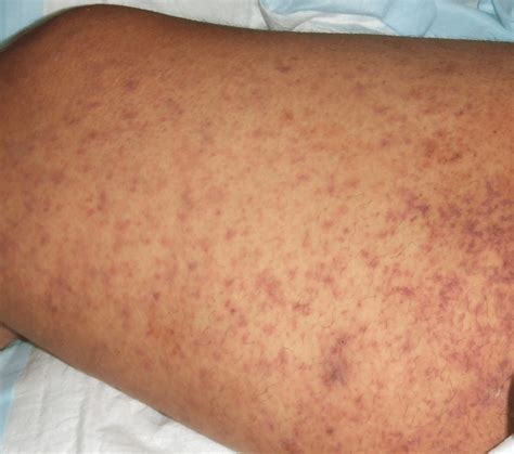 Petechial rash on a patient with Rocky Mountain spotted fever caused by ...