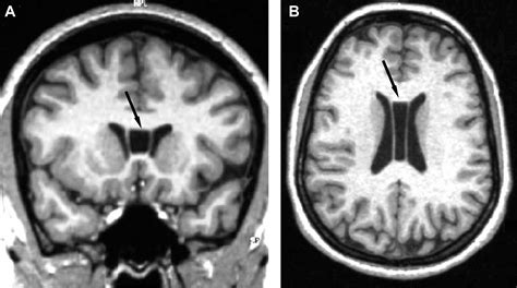 Cavum septum pellucidum and adhesio interthalamica in schizophrenia: an ...