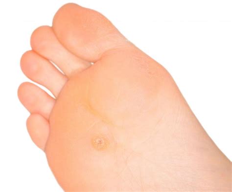 How To Get Rid Of Calluses On Feet