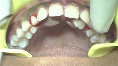 Extraction of retained primary maxillary canines - YouTube