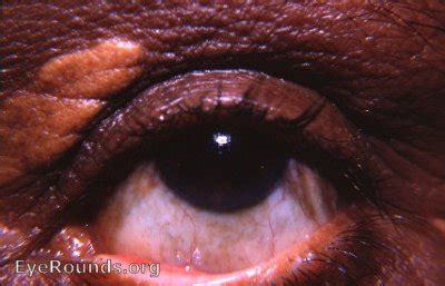 Xanthelasma