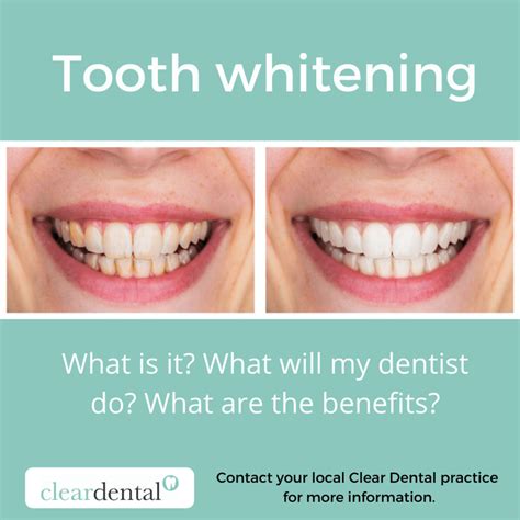 Tooth whitening – Clear Dental