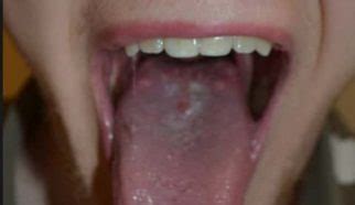 Main Causes of Large Bumps on Back of the Tongue | IYTmed.com