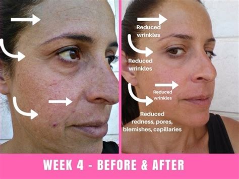 Project E Beauty LED Face Mask Before and After (30 Days)