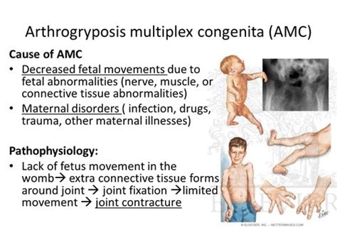 Neuromuscular Diagnosis Flashcards | Quizlet