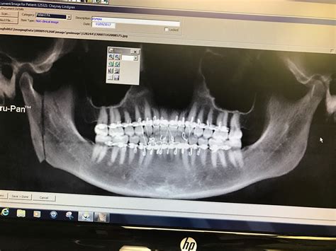 Cheyney and Ryan's Blog: Intraoral vertical ramus osteotomy