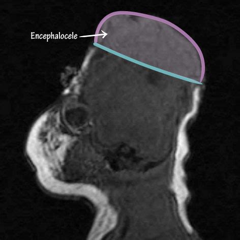 Neuroanatomy Glossary: Encephalocele & Cephalocele | ditki medical ...