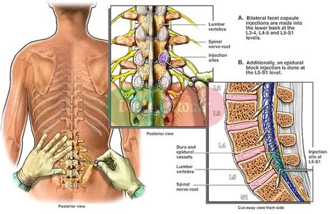 Spinal Injections | Castle Hill Diagnostics