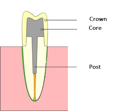 Everything you need to know about Post and Core Post and core in Pune - Dr Bari Dental Clinic