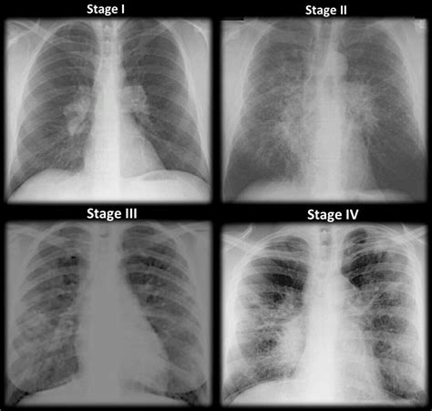 Sarcodiosis stages | Radiology imaging, Emergency nursing, Medicine student