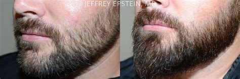 Facial Hair Transplant | Beard Trasplant | Miami, FL | New York, NY