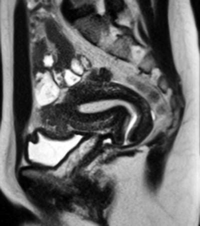 Fig. 3.1, [Normal MRI Uterine Anatomy Sagittal...]. - Diseases of the Abdomen and Pelvis 2018 ...