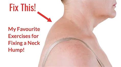 Neck Hump Exercise Worksheet | Milton Chiropractic Clinic