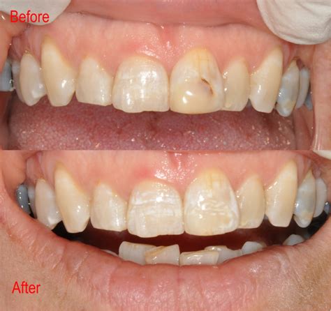 Before and After # 3 | Burpengary Dental