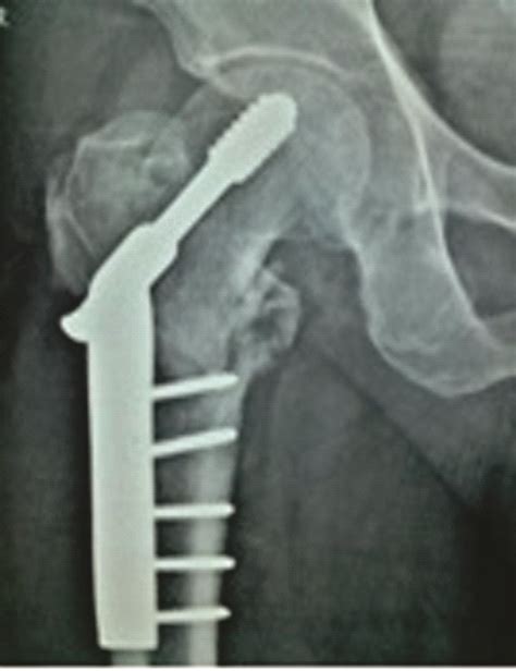 Hip Instability following DHS Fixation Surgery for Unstable Four Part Per-Trochanteric Fracture ...