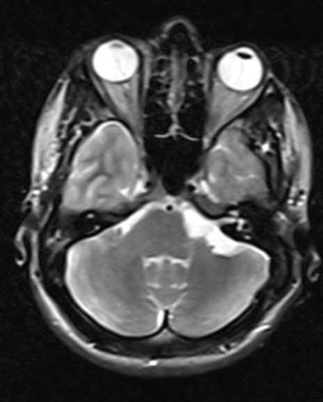 Cerebellopontine Angle Epidermoid-MRI - Sumer's Radiology Blog