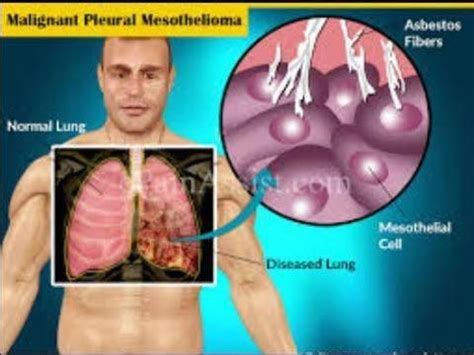 Is Stage 4 Bile Duct Cancer Curable