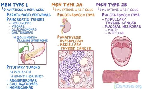 Multiple Endocrine Neoplasia - MEDizzy