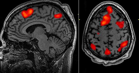 Mri Scans Brain