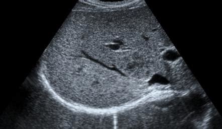 Generalised increase in hepatic echogenicity | Radiology Reference ...