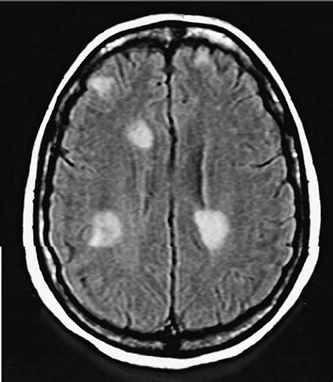 MRI scan of head demonstrating multiple ring enhancing lesions. | Download Scientific Diagram