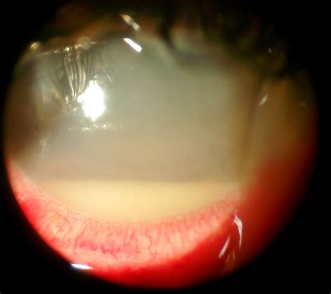 Endophthalmitis - EyeWiki