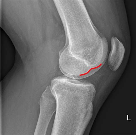 Lateral Femoral Condyle