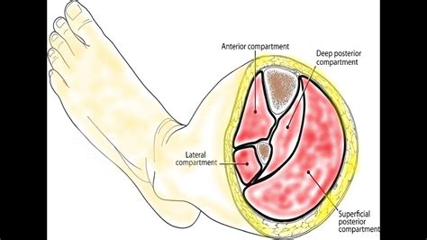 Fasciotomy of the Leg. - YouTube