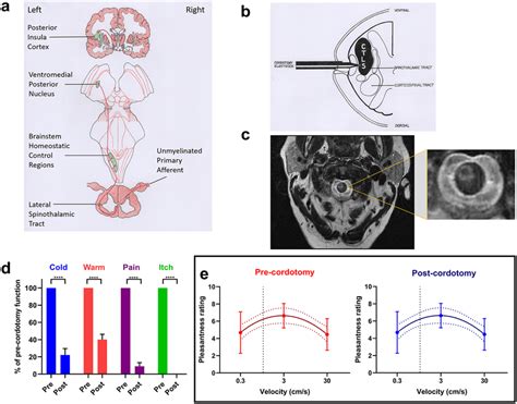 Anterolateral cordotomy induces marked deficits in canonical lamina ...