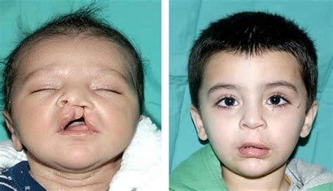 Cleft Lip & Cleft Palate: Causes & Treatment
