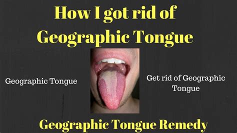 Favorite Tips About How To Get Rid Of Geographic Tongue - Settingprint