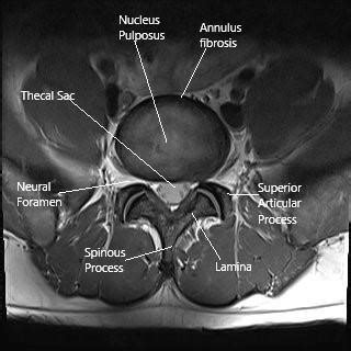 Spine Tumors - Complete Orthopedics | Multiple NY Locations