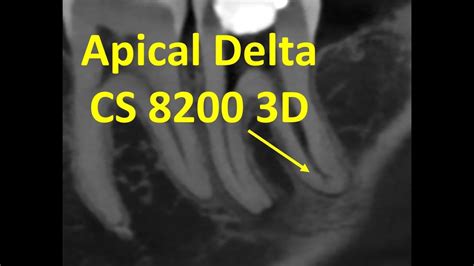 CS 3D Imaging - Apical Delta - YouTube