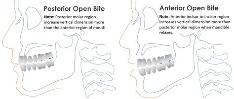 TMD: Anterior Open Bite Tendency Problems | Occlusion Connections