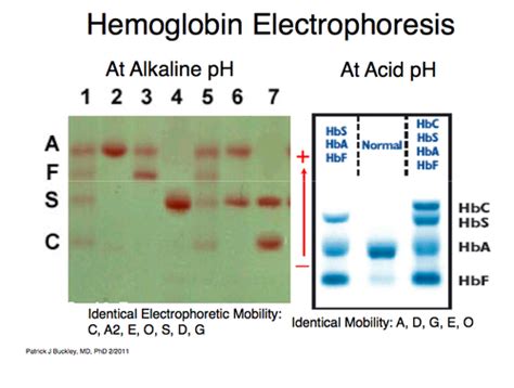 First Aid p391: Hemoglobin Electrophoresis Flashcards | Quizlet