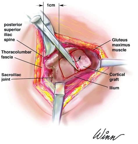 Illiac Crest Bone Graft Anatomy