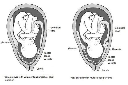 Vasa praevia - Wikipedia