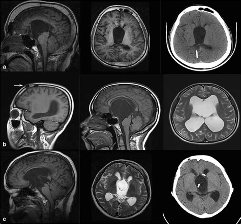 a–c Preoperative MRI and CT scans of the patients with a prior VP shunt ...