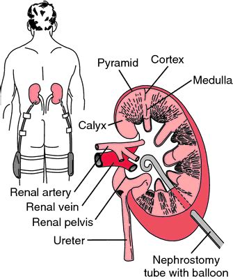 Nephrostomy | definition of nephrostomy by Medical dictionary