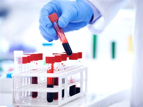 Protein Electrophoresis Serum Test