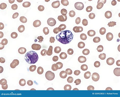 Cryptococcus in Peripheral Blood Smear. Stock Photo - Image of blood ...