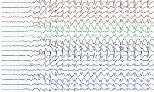 Common Epilepsy Syndroms Flashcards | Quizlet