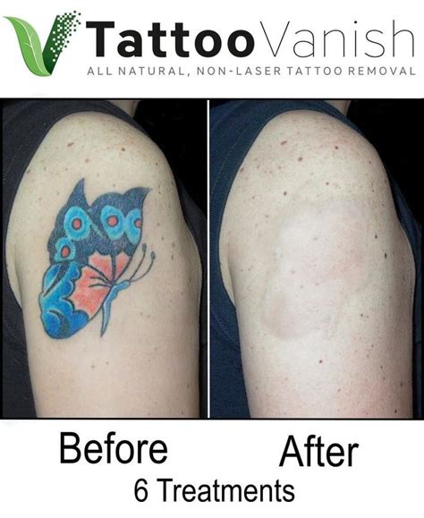 Before and After Tattoo Removal - Get the Best Results the All-Natural Way | Tattoo Vanish ...