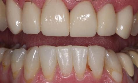 Misaligned , Misshapen, and Discoloured Teeth | Guelph, Ontario