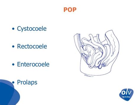 Robotic Sacrocolpopexy OLV