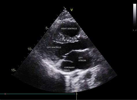 Dilated Coronary Sinus Echo | My XXX Hot Girl