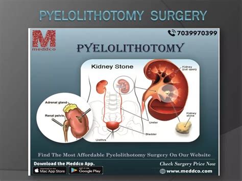 PPT - PYELOLITHOTOMY SURGERY PowerPoint Presentation, free download ...