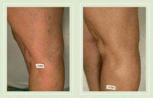 Reticular Veins: What You Should Know? - Varicose Vein Treatment NYC